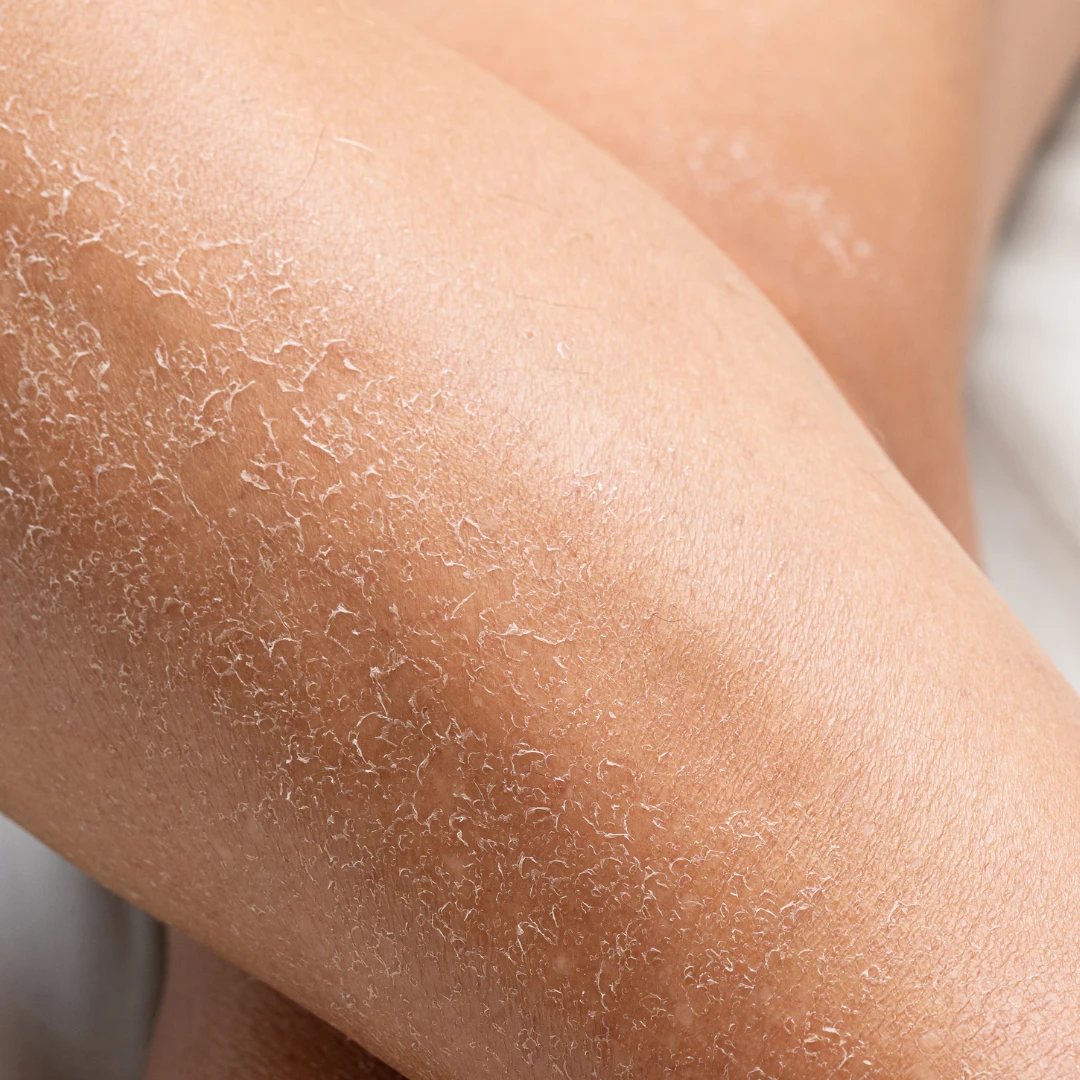 Kuiv ja ketendav nahk