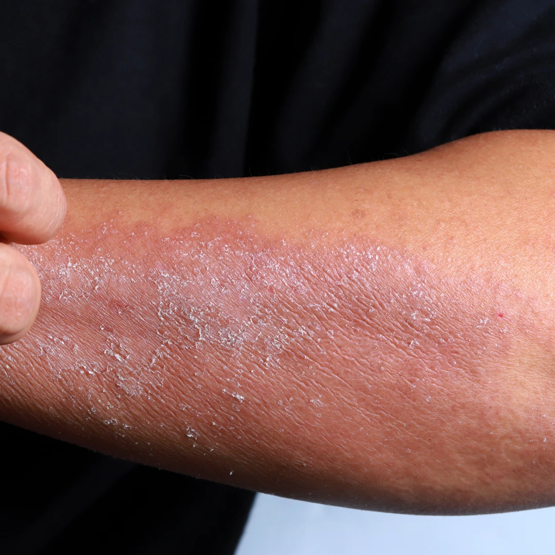 Nordenbeauty koorimiskinnas aitab ketendava naha vastu